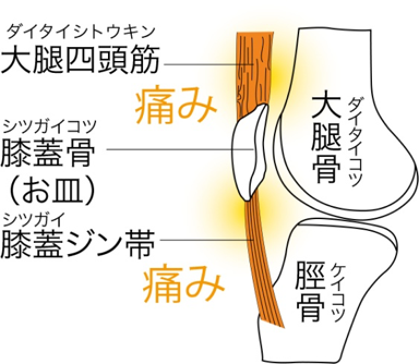 ジャンパーひざ（膝蓋ジン帯炎）