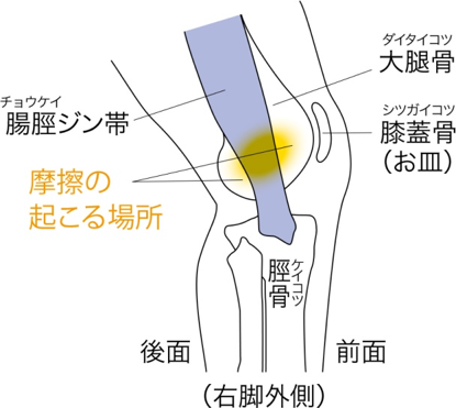 ランナーひざ（腸脛ジン帯炎）