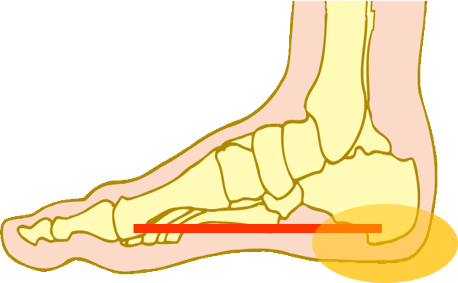 足底筋膜炎